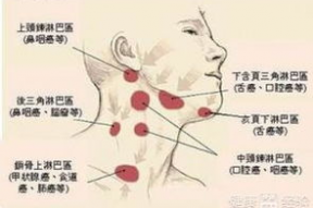 淋巴癌晚期图片